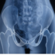 DEXA Bone Density Scanning